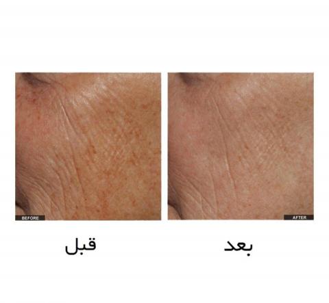 فروشنده دستگاه آکوا فیشیال  صادراتی